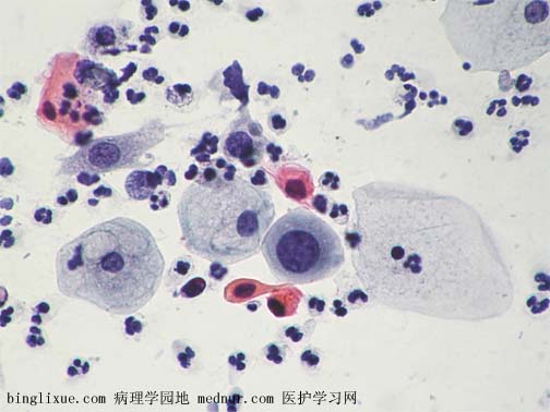 ǵ״ϸ߼״Ƥڲ䣨atypical squamous cell cannot exclude HSIL, ASC-H