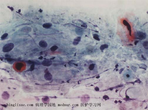 ǵ״ϸ߼״Ƥڲ䣨atypical squamous cell cannot exclude HSIL, ASC-H