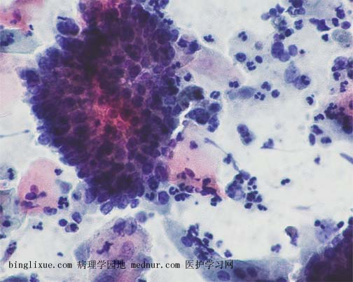 ӹٰendocevical adenocarcinoma