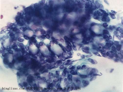 ӹٰendocevical adenocarcinoma