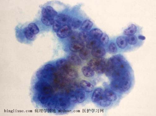 ӹٰendocevical adenocarcinoma