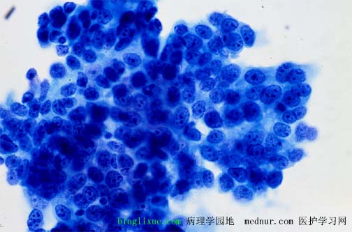 ӹٰendocevical adenocarcinoma