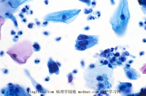 ӹٰendocevical adenocarcinoma