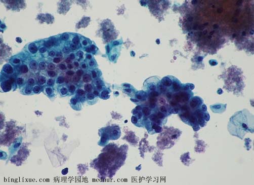 ӹٰendocevical adenocarcinoma