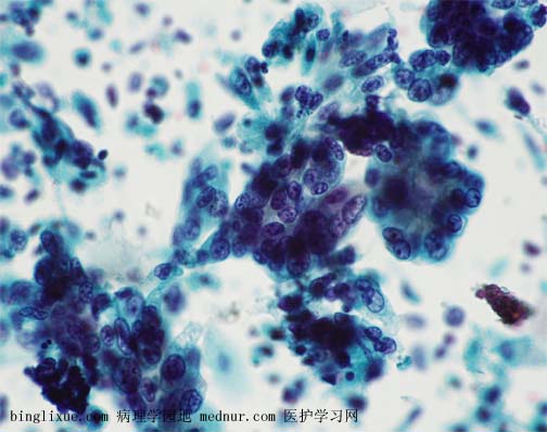 ӹٰendocevical adenocarcinoma