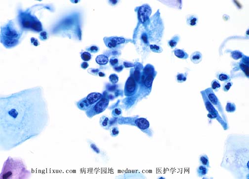 ӹٰendocevical adenocarcinoma