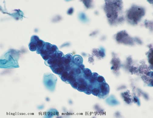 ӹٰendocevical adenocarcinoma