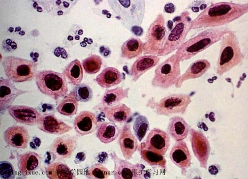 高级别鳞状上皮内病变(high-grade squamous intraepithelial lesion