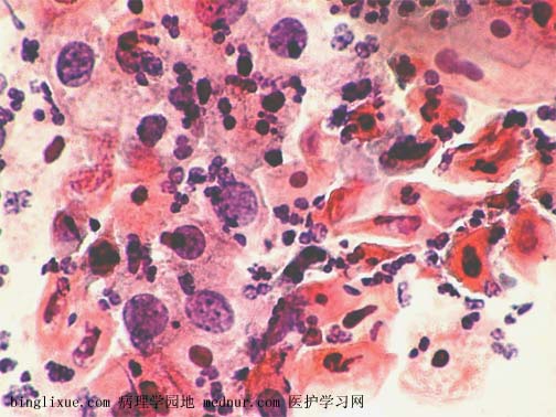 ǻ״ϸ (keratinizing squamous cell carcinoma )