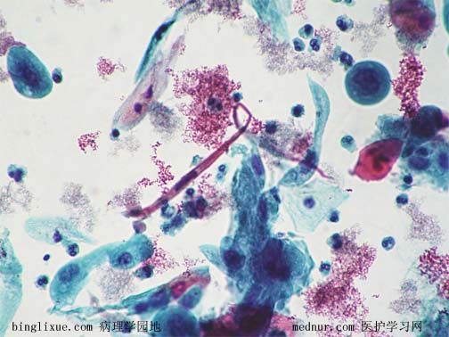 ǻ״ϸ (keratinizing squamous cell carcinoma )