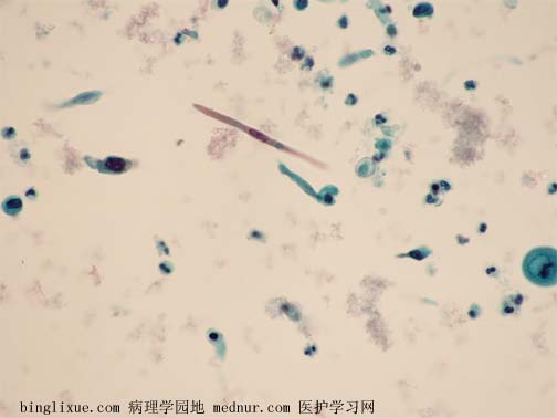 ǻ״ϸ (keratinizing squamous cell carcinoma )ҺͿƬ