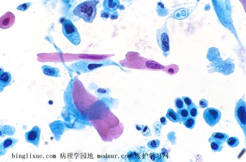 ǻ״ϸ (keratinizing squamous cell carcinoma )ҺͿƬ