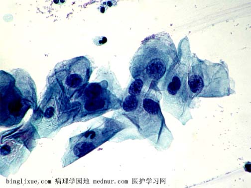 低级别鳞状上皮内病变(low-grade squamous intraepithelial lesion