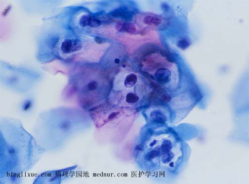 低级别鳞状上皮内病变(low-grade squamous intraepithelial lesion