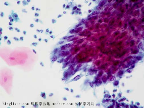 ǽǻ״ϸ (nonkeratinizing squamous cell carcinoma)