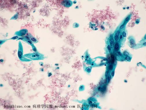 ǽǻ״ϸ (nonkeratinizing squamous cell carcinoma)