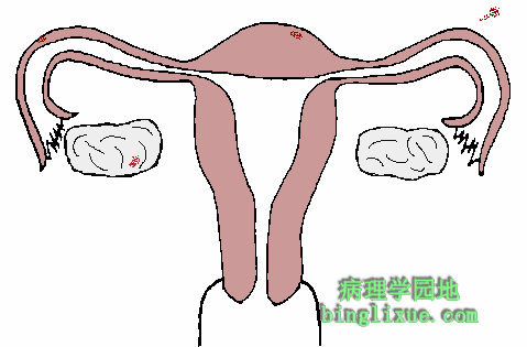 子宫内膜移位症的发生部位（模式图）