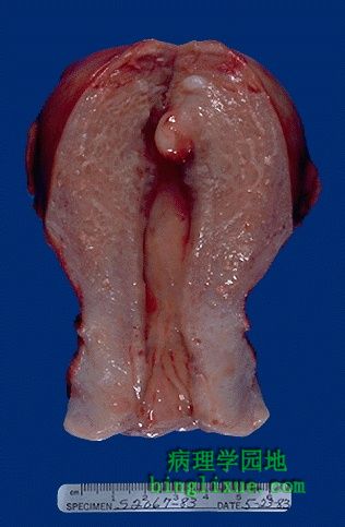 子宫底粘膜下子宫平滑肌瘤(大体)