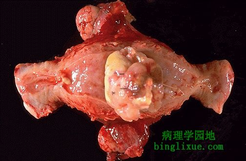 自肌层突向宫腔的平滑肌肉瘤（大体剖开）