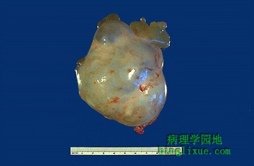 卵巢浆液性囊腺瘤