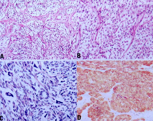 ͸ϸ ( clear cell sarcoma CCS)