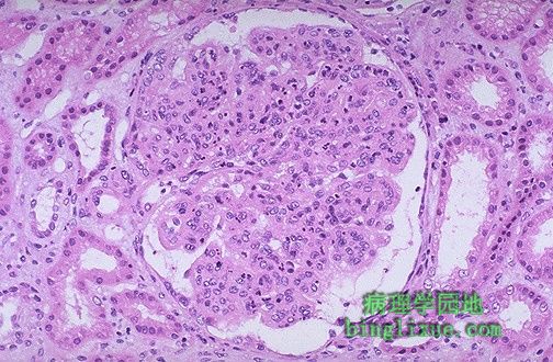 Poststreptococcal Glomerulonephritis