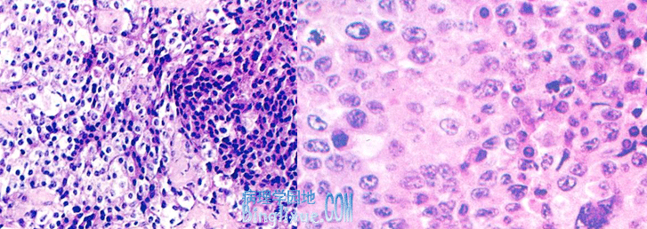 肾上腺皮质腺瘤：右侧为嗜酸细胞，左侧为透明细胞 肾上腺皮质腺癌：细胞异型性明显，较多病理核分裂