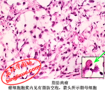 来自纤维结缔组织的肉瘤,其发生部位与纤维瘤相似,以四肢皮下组织为多