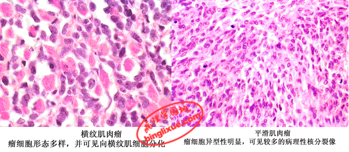 横纹肌肉瘤_平滑肌肉瘤