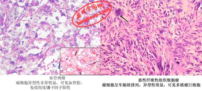 左胫骨良性纤维组织细胞瘤1例