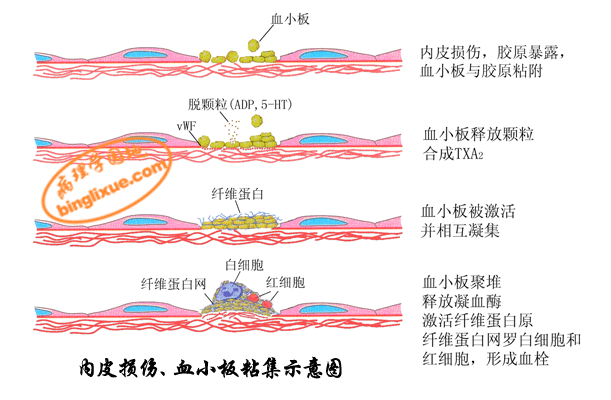 内皮损伤、血小板粘集