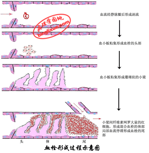 血栓形成