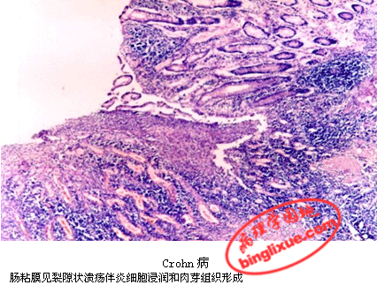 crohn