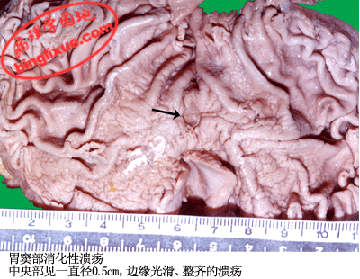 消化性溃疡肉眼观